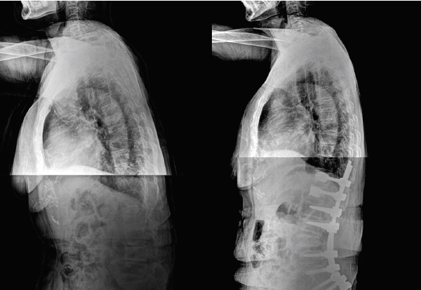 요추 후만증 수술 전후 X-ray 사진