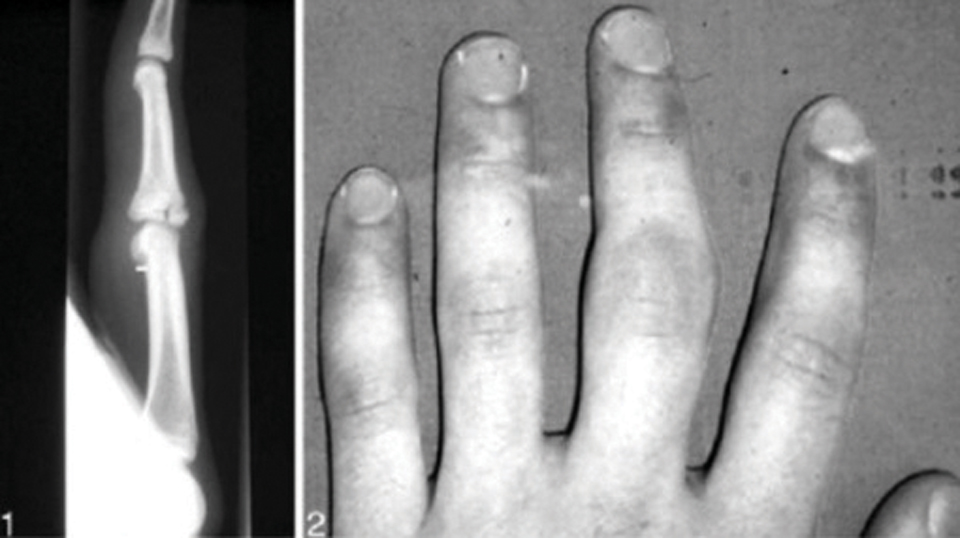 손가락 성장판 골절 부상을
입은 15세 클라이머의 손가락.
사진 야생환경의학저널